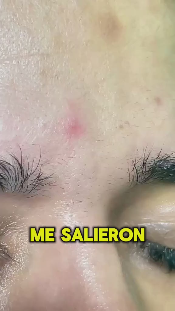 SERUM SECADOR DE BARROS